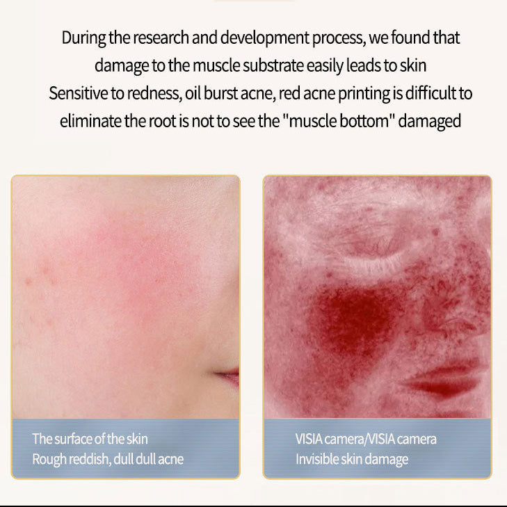 Salicylic Acid Acne Gel – Oil Control, Pore Minimizing & Breakout Treatment