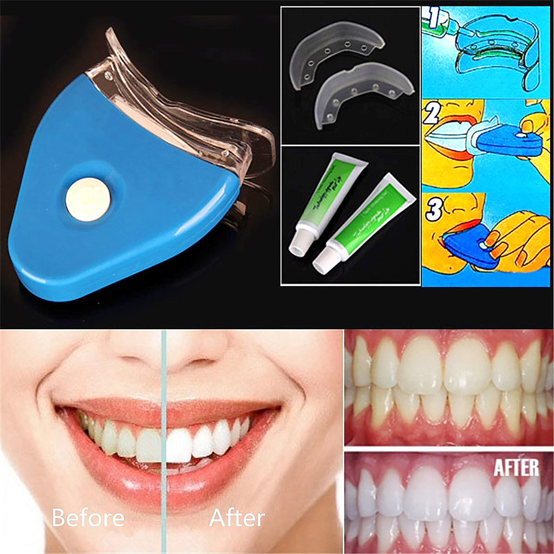 Teeth Whitening Kit with LED Light – Remove Stains & Brighten Smile Fast